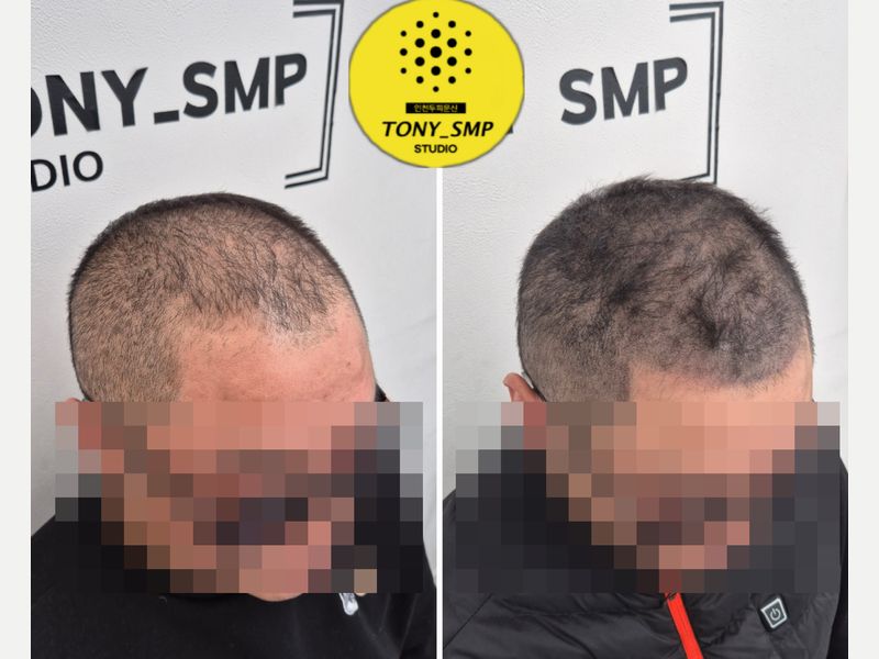 인천 두피문신 삭발 디자인 SMP 시술 전후 사례 2 — 왼쪽 시술 전 · 오른쪽 시술 후