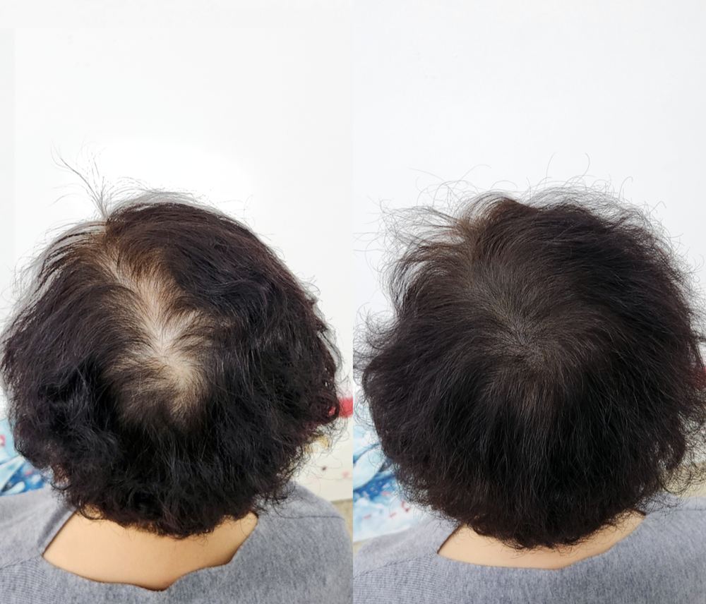 정수리 SMP 시술 전후